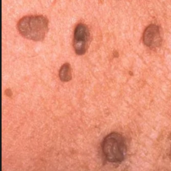 Skin Tag Removal